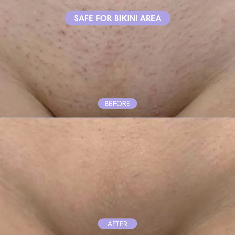 Smoothé — Body Hair Removal Spray